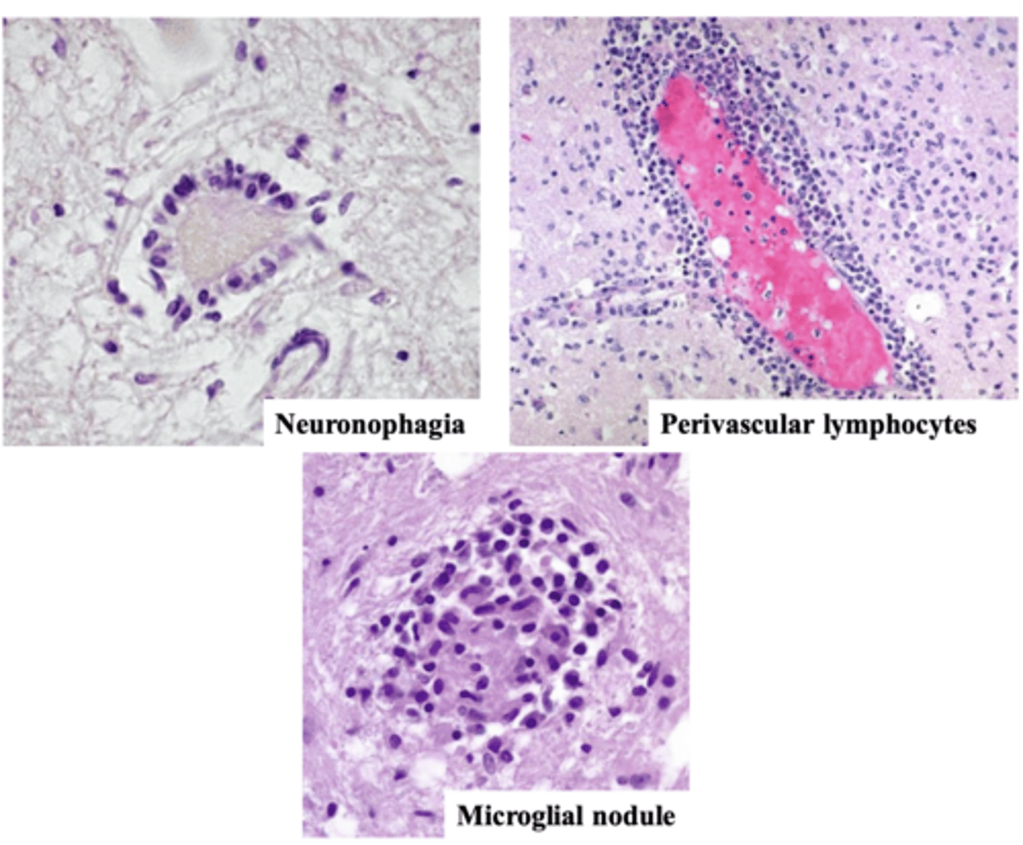 <p>microscopic presentation of encephalitis (not specific for any type of virus -> with any of them)</p>