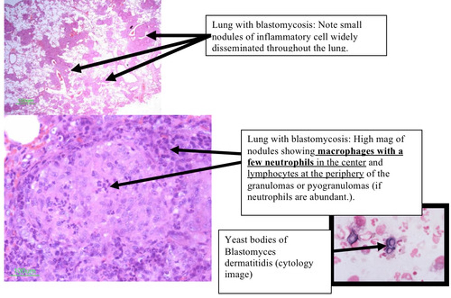<p>Provide morphological diagnosis - this is from a lung</p>