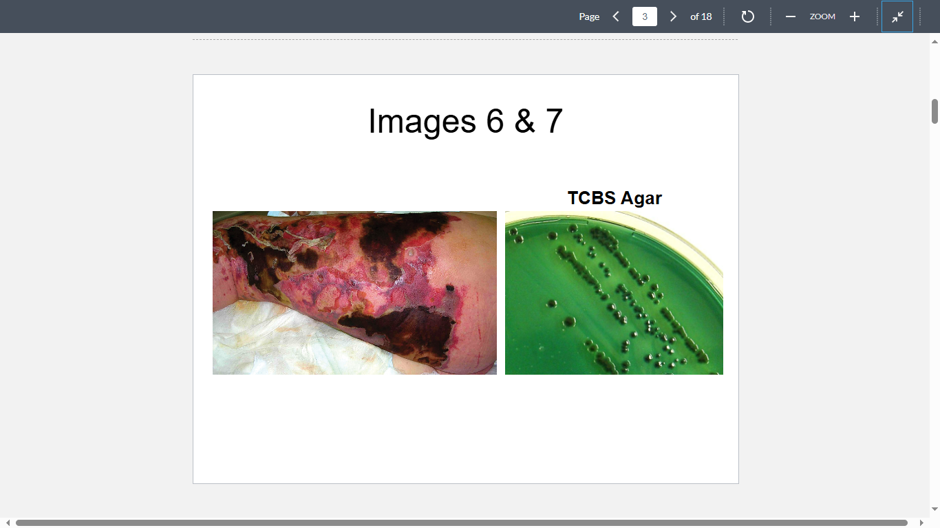 <p>A 58-year-old man was admitted to his local community hospital with a painful, swollen leg displaying massive denudation of the epithelium (Image 6). Upon questioning, the patient’s family recounted that the patient had cut himself while fishing in the Gulf of Mexico. A blood sample revealed the following organism (Image 7). Despite extensive treatment, the patient died on day 7 from multiple organ dysfunction. What organism is the most likely cause?</p>