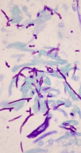 <p>8.9 Side A (PBD9: 386; BP9: 502)<br></p>
<p><br></p>
<p>Questions<br></p>
<p>A 29-year-old man with leukemia develops fever and cough after chemotherapy; bronchoalveolar lavage PAS stain is shown.<br></p>
<p><br></p>
<p>1. What infection does he have?<br></p>
<p>2. What is missing from his WBCs?<br></p>
<p>3. What are some virulence factors?<br></p>
<p>4. Could this be a false positive?<br></p>