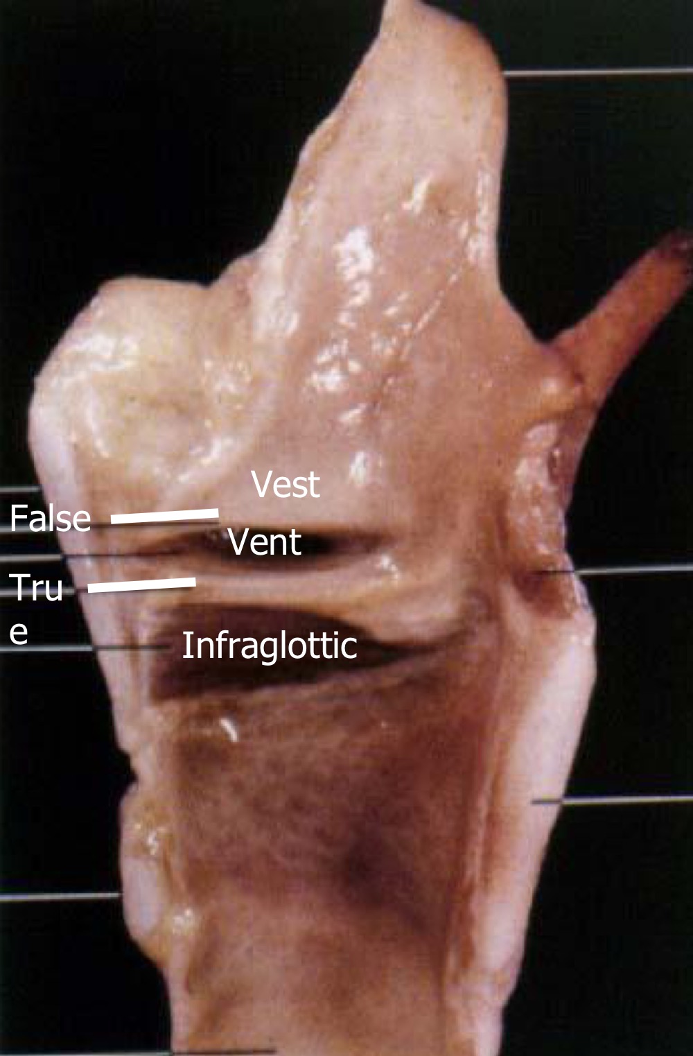 between the true and false vocal folds