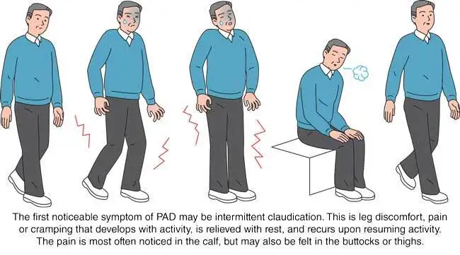 <ul><li><p>FDA: <strong>Intermittent claudication</strong> in PAD</p></li><li><p>Non-FDA:<strong> Buerger’s disease</strong>, diabetic vascular sclerosis, chronic cerebral ischemia</p></li></ul><p></p>
