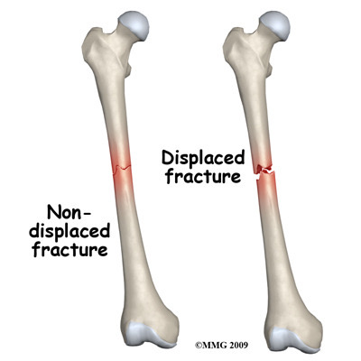 <p>Non displaced fracture</p>