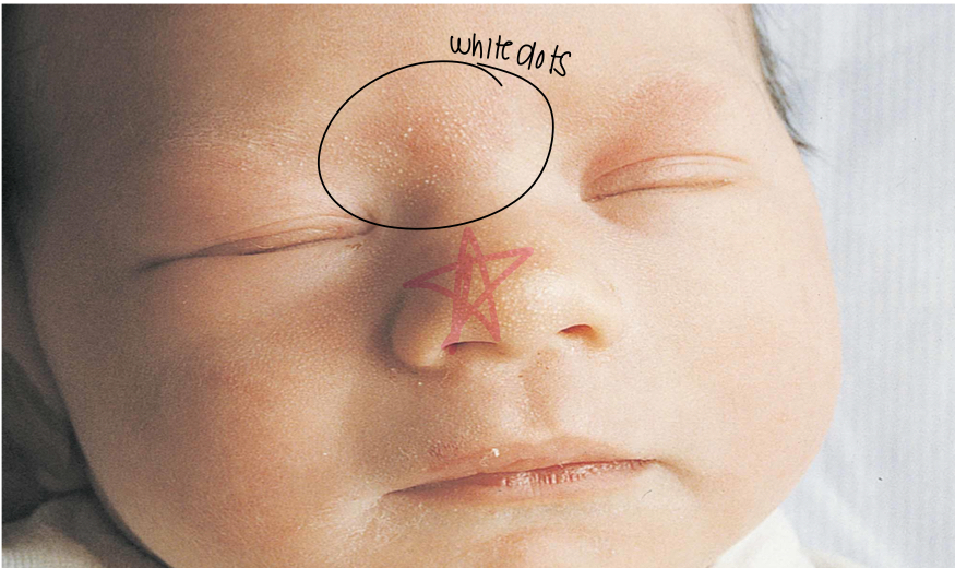 <p>Newborn acne </p>