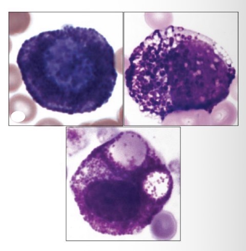 <p>Large, round nu, purple cytoplasmic granules, not seen in health</p>