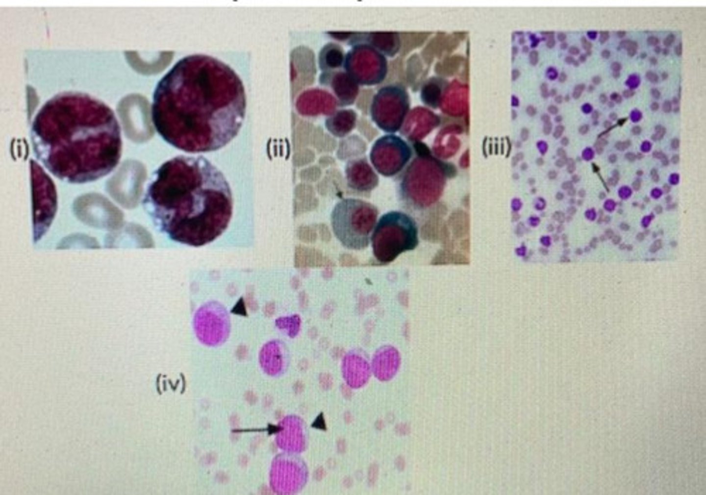 <p>Which photo indicates acute myelogenous leukaemia?</p>