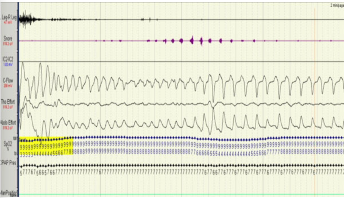 <p>The following 120-second respiratory tracing is observed while an adult patient is in N3 sleep. Which of the following best describes the event in this tracing?</p>