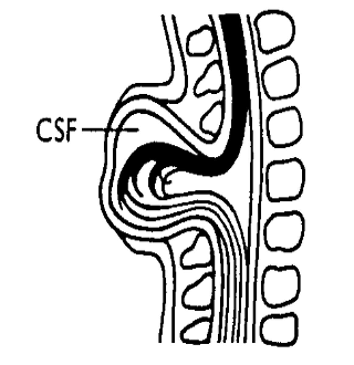 <p>- Protrusion of meninges and spinal cord through vertebral defect.</p><p>- 80% in lumbar and sacral regions</p><p>- Involvement of neural tissue with paralysis of limbs and abdominal muscle, loss of sensation and incontinence</p><p>- Most severe and common form</p><p>- Surgery usually required, prior to or soon after birth</p>