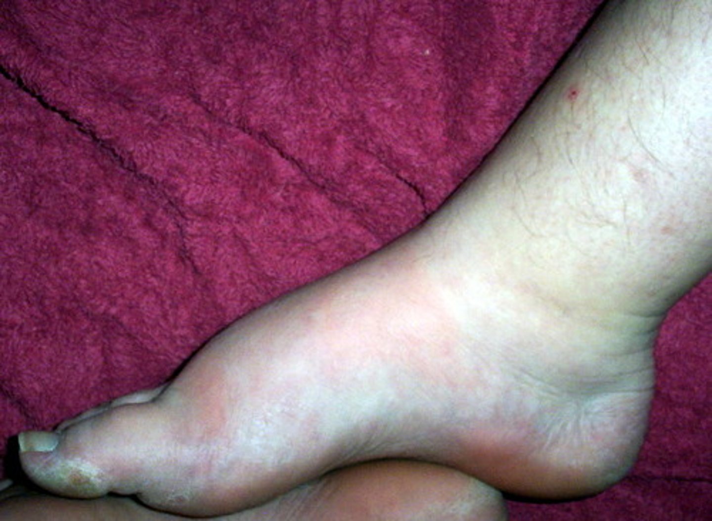 <p>inflammation, swelling</p>