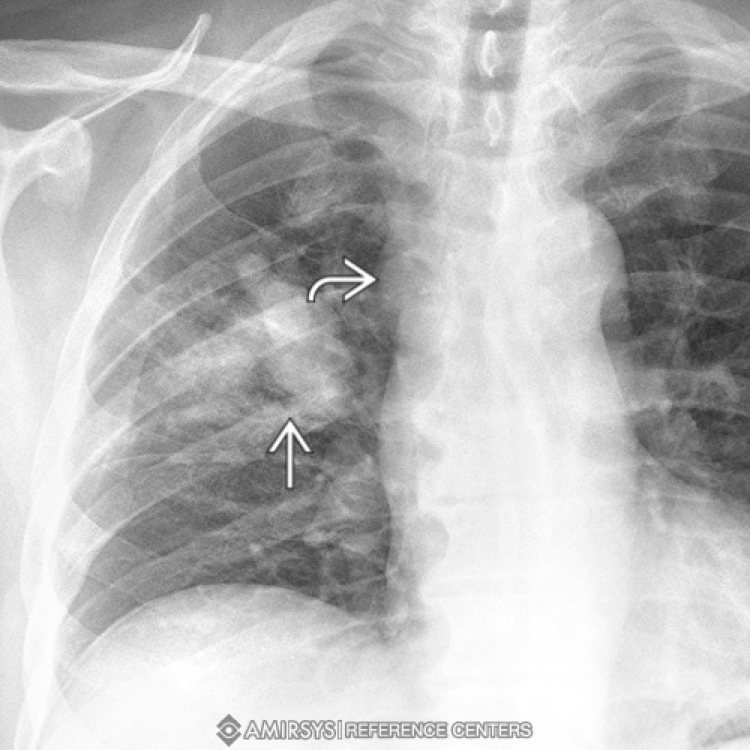 <p>small cell lung carcinoma (SCLC) </p>