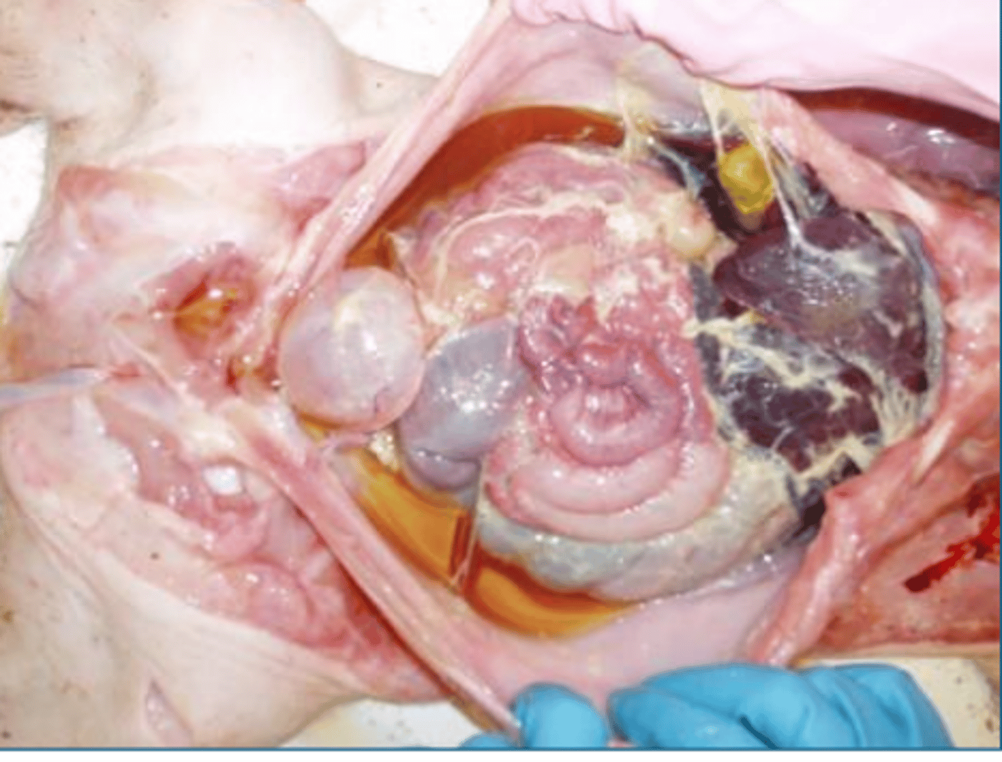 <p>what type of exudate is depicted in the image?</p>