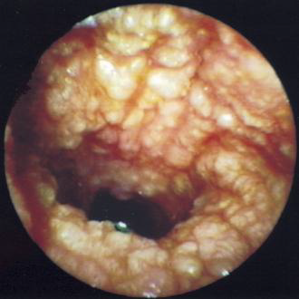 <p>hyperplasia of the ceruminous gland</p>