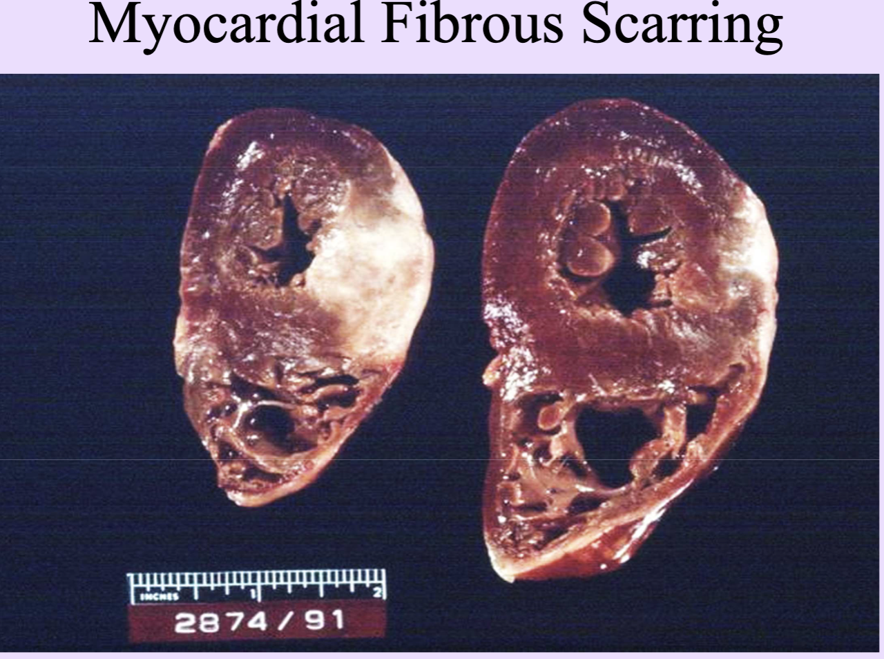 <p>Nondividing cells (neurons, myocardium) that repair by scarring.</p><ul><li><p>heart repair = fibrous scarring</p></li><li><p>Brain repair by Gliosis</p></li></ul><p></p>