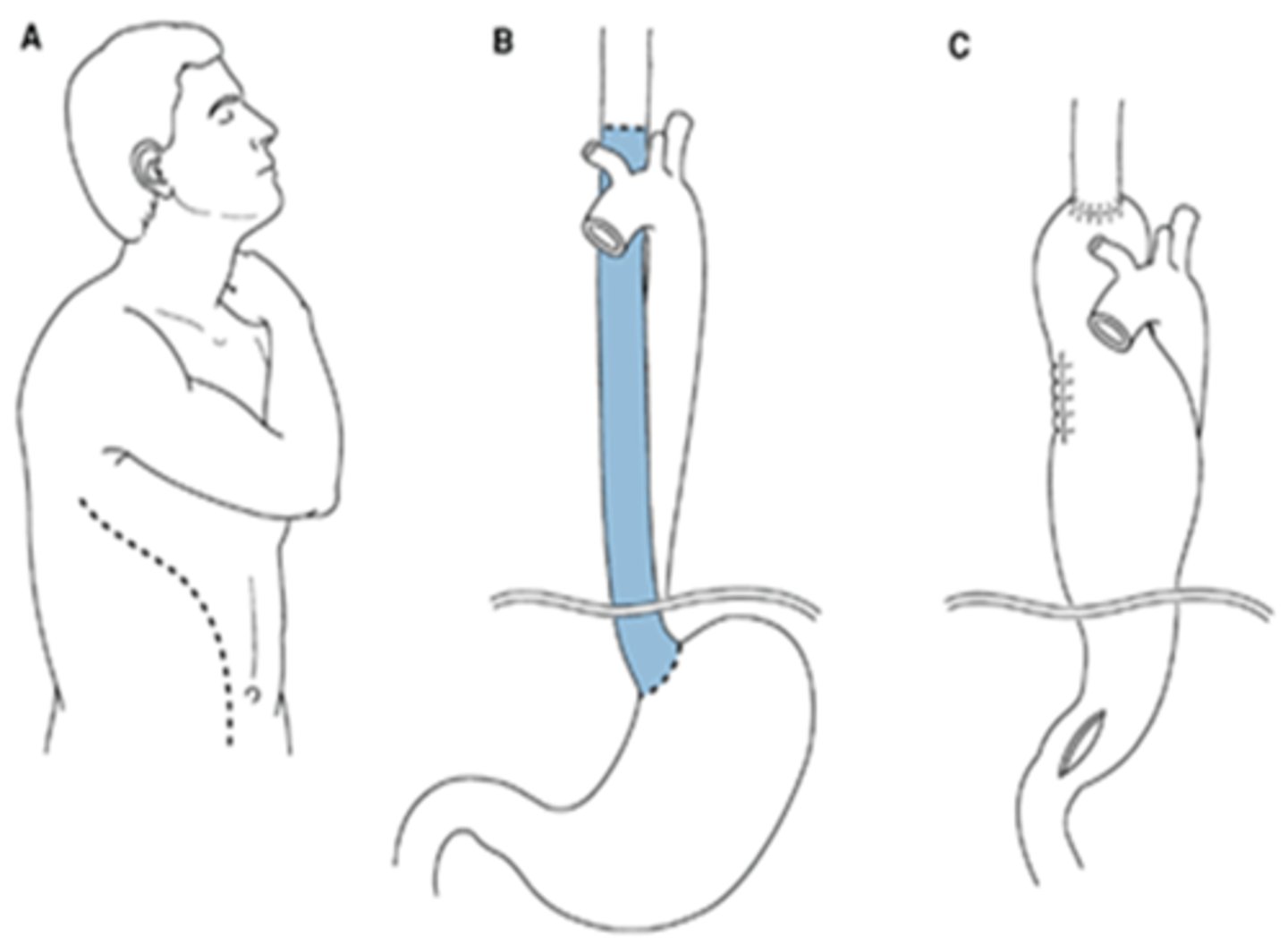 <p>aka Ivor Lewis Esophagectomy </p><p>Pull stomach into chest, 1-2 pigtail catheters/chest tubes to re-expand lung, drainage for leak of anastomoses</p>