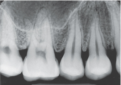 <ul><li><p><span style="font-family: Aptos, sans-serif">used to examine the entire tooth and supporting bone, examine “around apical”</span></p></li><li><p><span style="font-family: Aptos, sans-serif">uses __ receptor</span></p></li><li><p><span style="font-family: Aptos, sans-serif">utilized paralleling and bisecting technique*</span></p></li></ul><p></p>