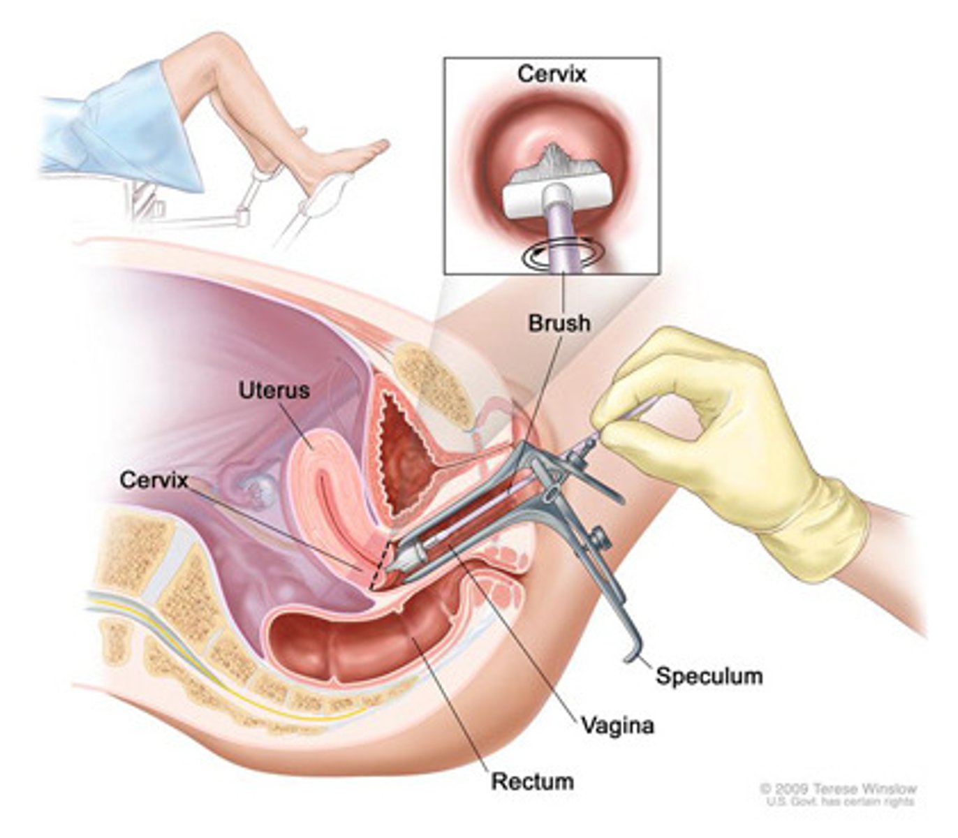 <p>method or exam. Stained exfoliative cells. Used to detect cancers of cervix</p>
