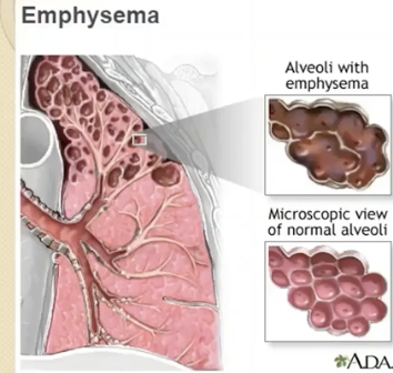 <p>decrease in elastic recoil, increased air resistance (excess mucus) → difficulty with expiration.</p><p></p><p>the lungs are more compliant and less elastic. when they breathe out, the airways collapse and trap alveolar air.&nbsp;&nbsp;</p>