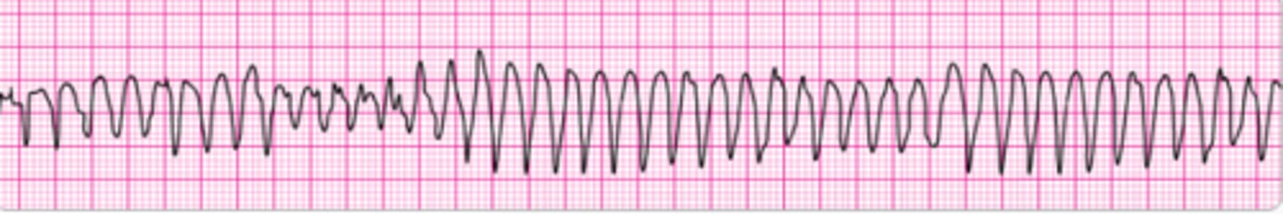 <p>Identify the rhythm.</p>