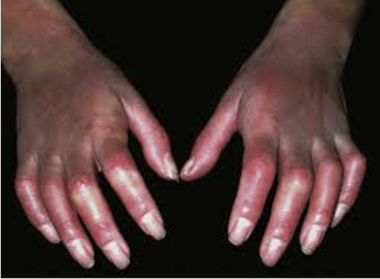 <p>Development of thick, waxy skin that can lead to joint stiffness; may develop secondary to DM</p>