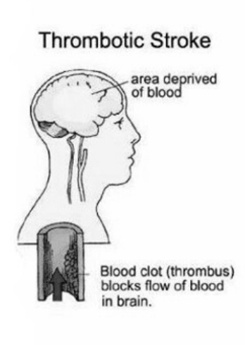 <p>walls of the vein is coated in stuff</p>