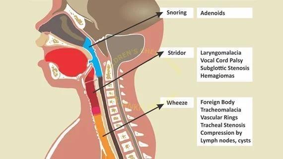 <p>stridor (and what does it indicate) </p>