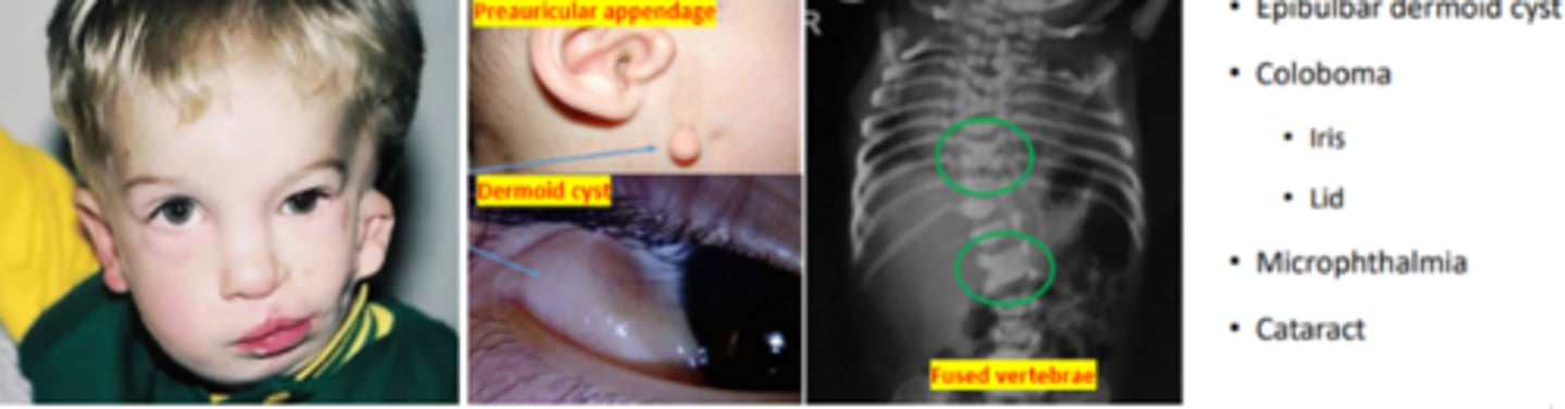 <p>syndrome involving malformation of the ear, eye, and vertebra. Is the second most common cranio-facial syndrome. Appears as a triad of craniofacial microsomia, spinal abnormalities, and ocular dermoid cyst. Is more common in males (3:2).</p>