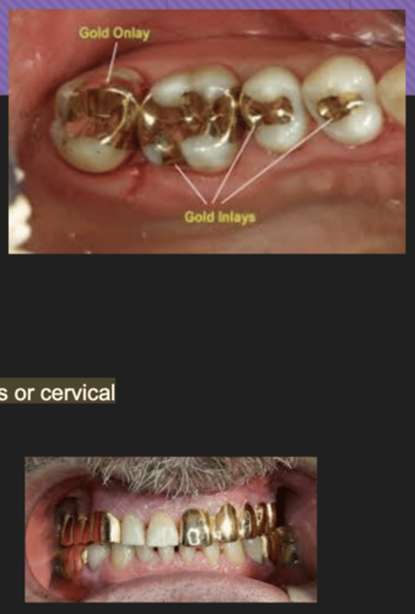 <p>Radiopaque</p><p>- Gold crowns and bridges</p><p>- Gold inlays and onlays</p><p>- Gold foil restorations - usually occlusals or cervical</p>