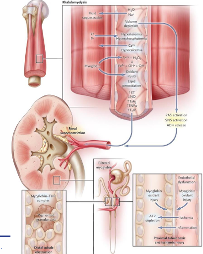 <p>-breakdown of skeletal muscle</p><p>-intracellular myoglobin, K+ and P- released</p><p>-results in hyperkalemia, hyperphosphatemia, hypocalcemia, volume depletion, and oxidative stress</p><p>-intense renal vasoconstriction, oxidative toxic ATN, and pigmented granular myoglobin casts with obstruction</p><p>-urinalysis +blood (myoglobin Fe) but few RBCs on microscopy</p>