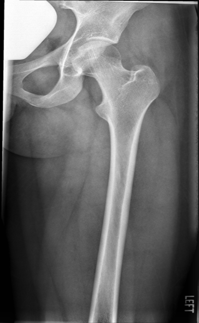<p>what is the image critique of this AP femur?</p>