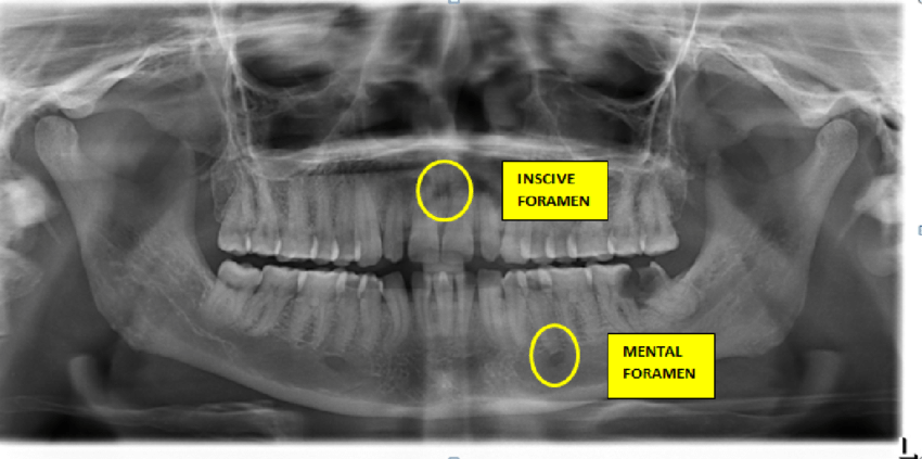 <ul><li><p>Radiolucent</p></li><li><p>Ex. Mental Foramen, Incisive Foramen  </p></li></ul><p></p>