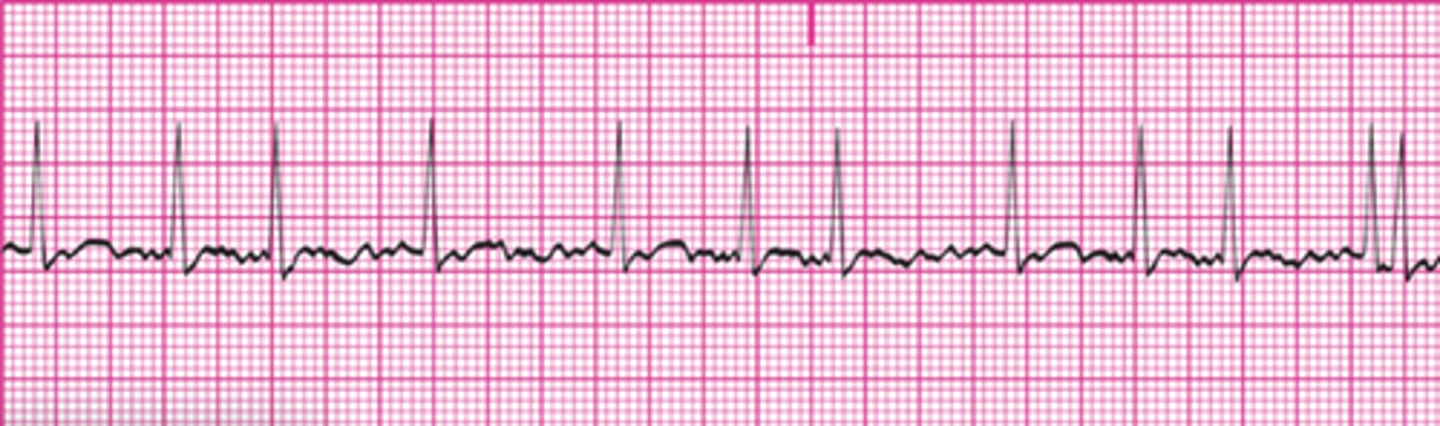 <p>Atrial fibrillation</p>
