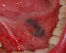 <p><span>usually </span><span style="color: red;"><span>an incidental finding</span></span></p><p><span>amalgam </span><span style="color: red;"><span>in the gingiva, alveolar process, palate, or buccal mucosa </span></span><span>may produce a tattoo</span></p><ul><li><p><strong>clinical consideration:</strong></p><ul><li><p>dental team must be able to conclusively differentiate an amalgam tattoo from other types of intraoral pigmented lesions</p></li></ul></li></ul><p></p>