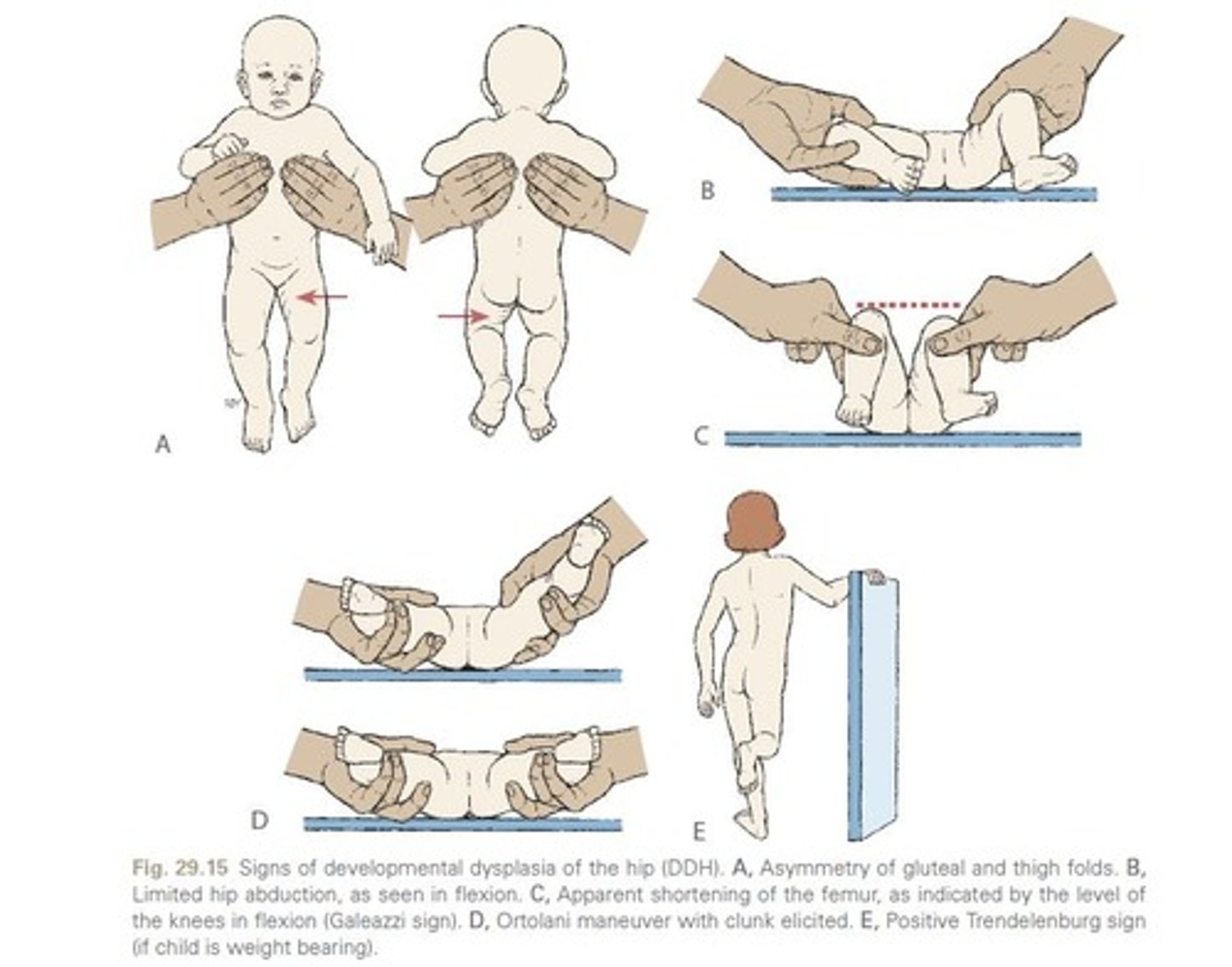 <p>Asymmetry of the gluteal folds, limited hip abduction, and a positive Ortolani or Barlow test</p>