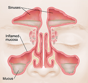 <p>Virus damages respiratory mucosa, triggering immune response.</p>