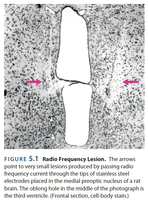 <p>→ small lesions made by passing an electric current through a metal wire insulated everywhere but the tip (whose heat will burn surrounding cells)</p><ul><li><p>Shape and size of lesion is determined by the duration and intensity of the current</p></li><li><p>Shortcoming is that passerby axons are burnt in the process</p></li></ul><p></p>