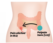 <ul><li><p>Palpation of left lower abdomen causes pain in the right lower abdomen.</p></li><li><p>positive in appendicitis</p></li></ul><p></p>