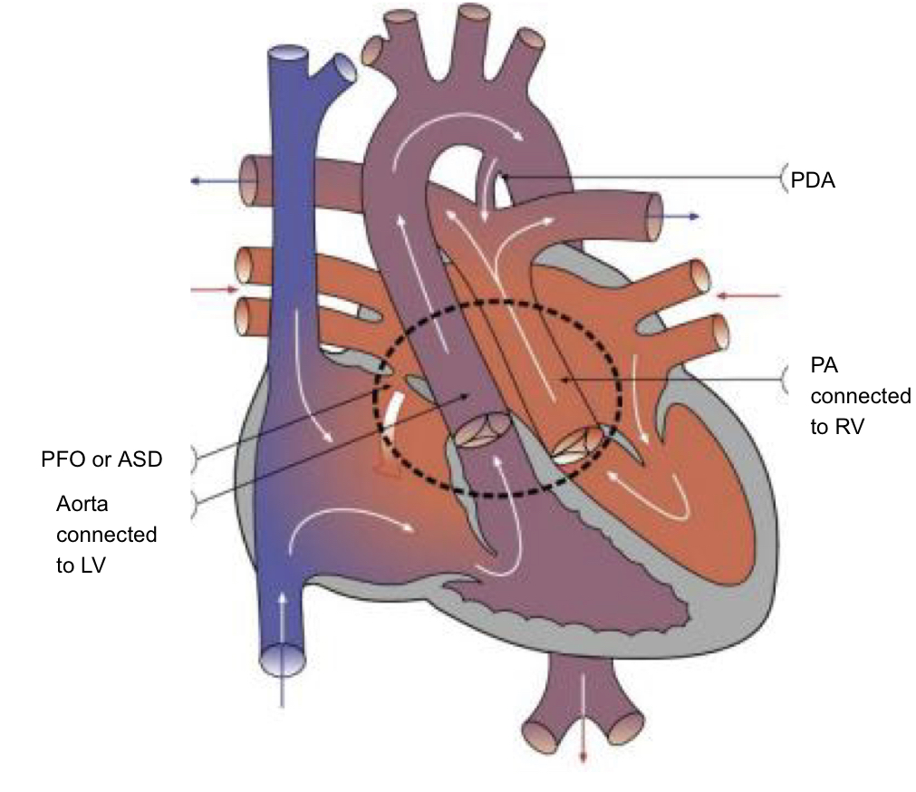 <ul><li><p>blood flow pathway</p></li><li><p>aorta rises from the right ventricle - no opportunity to be oxygenated in lungs</p></li><li><p>the pulmonary artery arises from the left ventricle - no opportunity for oxygenated blood to reach the body</p></li><li><p><strong>the child requires intracardiac mixing to survive</strong></p></li></ul><p></p>