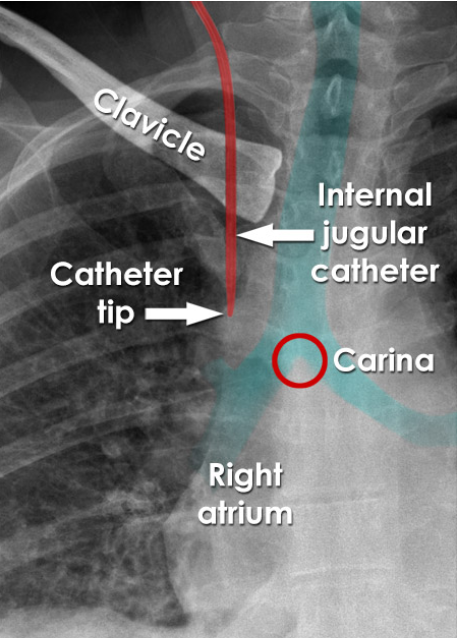 <p>Between the SVC and right atrium.</p>