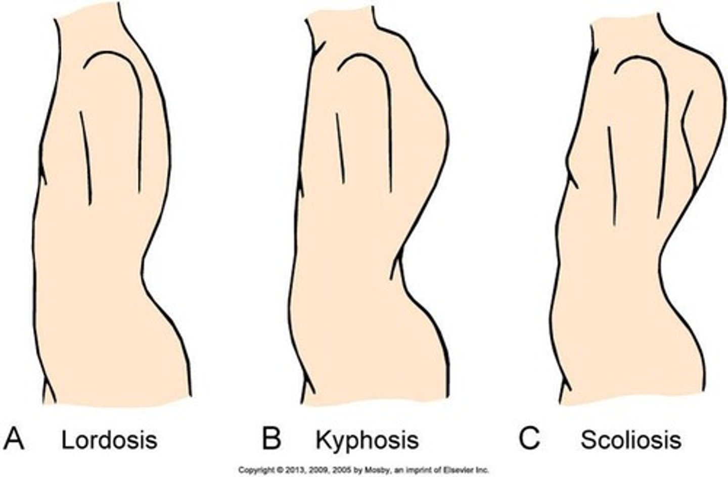 <p>Increased lumbar curvature.</p>