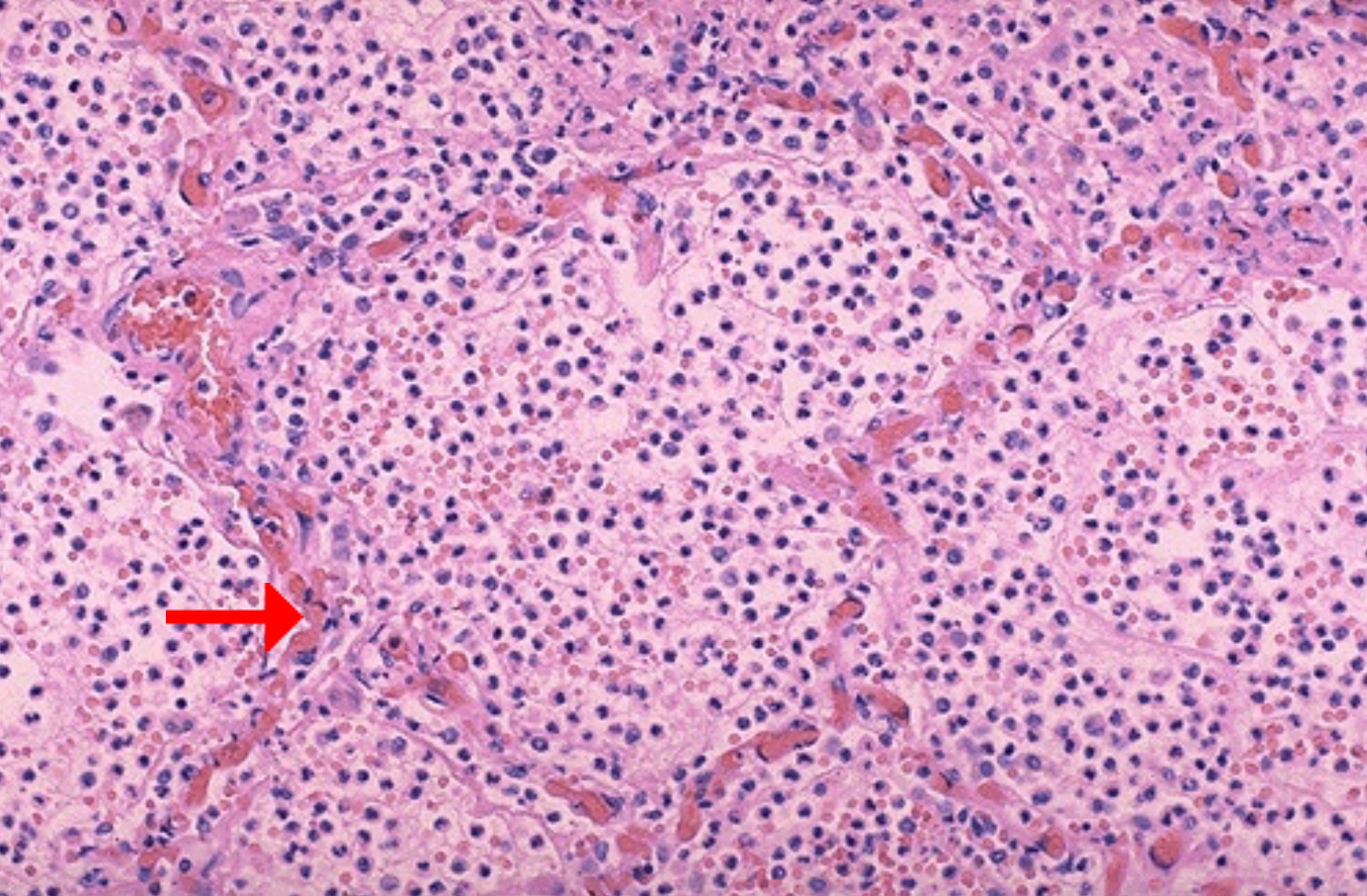 <ol><li><p>Consequence of alveolar infiltration</p><p></p></li></ol><p></p>