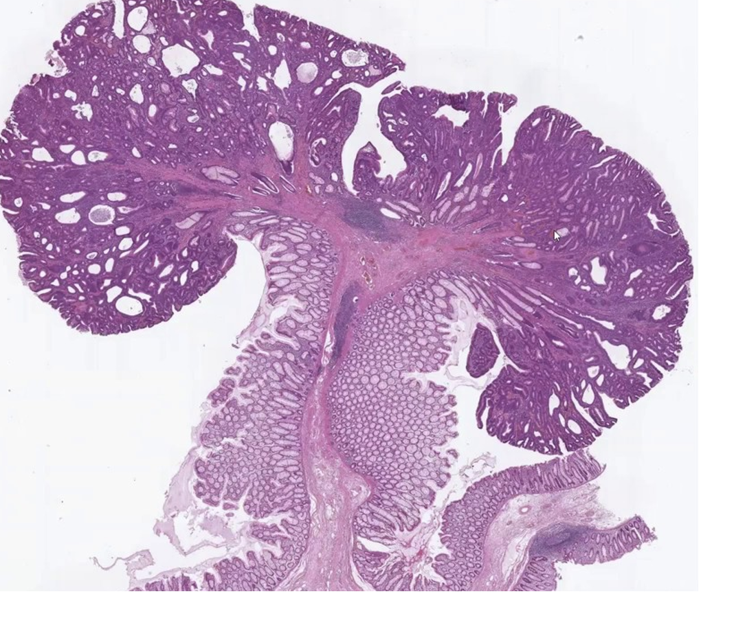 <p><span><span>Describe the gross appearance.</span></span></p><p style="text-align: left;"><span><span>What is the cell of origin?</span></span></p><p style="text-align: left;"><span><span>What is the diagnosis?</span></span></p><p style="text-align: left;"><span><span>What is the clinical significance?</span></span></p>