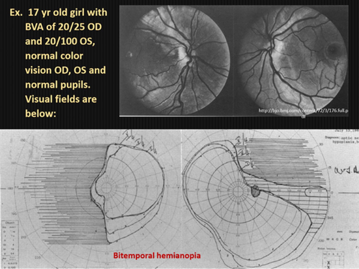 <p>most often as bitemporal hemianopsias but can be other defects anywhere in the VF, including binasal or ST defects </p>