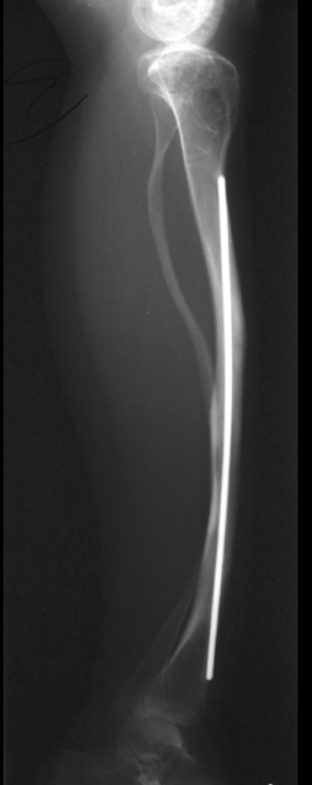 <p>Blue sclerae; joint laxity/muscle weakness.</p>