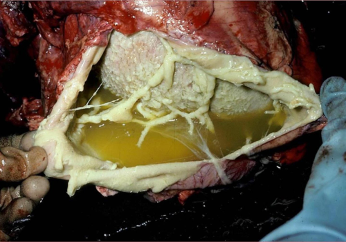 <p>what kind of effusion?</p>