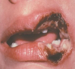 <p>caused by contact with electricity </p>