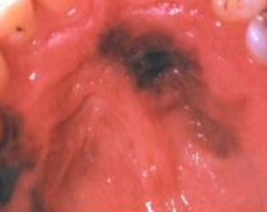 <p>What is the cause of melanoma?</p>