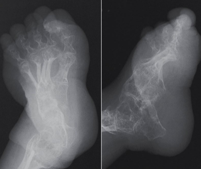 <ul><li><p>osteoporotic bones, thin cortices </p></li><li><p>callus formation</p></li><li><p>widened sutures, multiple wormian bone</p></li></ul><p></p>