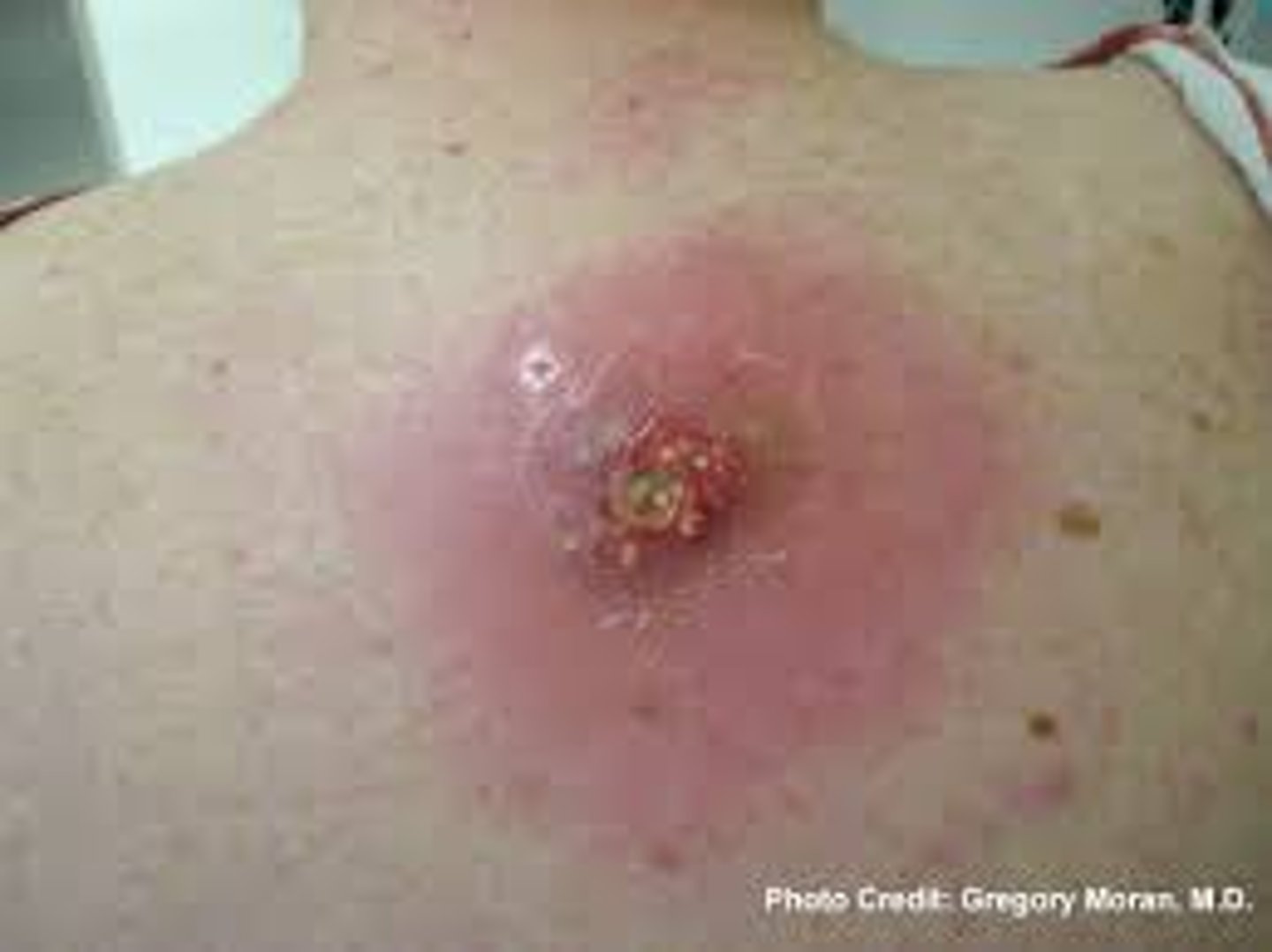 <p>Skin infections that may look like pimples or boils and can be red, swollen, painful, and full of pus</p>