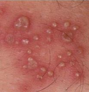 <p>vesicle, pustule, or bulla</p>