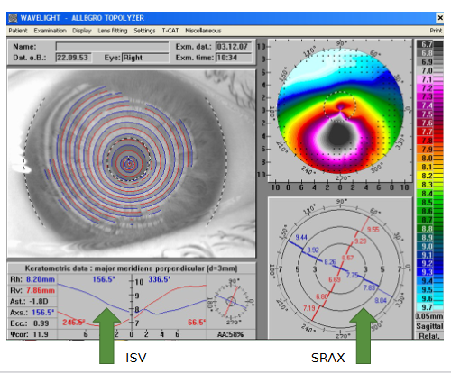 <p>Analysed area / extrapolated data / reflective device issues:</p><ul><li><p>Lids</p></li><li><p>Blinking / ptosis</p></li><li><p>Nose</p></li></ul><p></p>